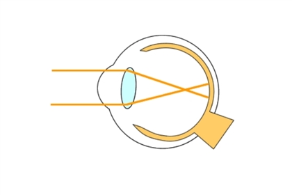 日本细胞研究的又一新发明——通过移植人体皮肤细胞能够抑制近视眼!?